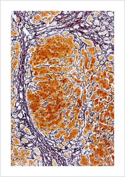 Cirrhosis of the liver, light micrograph