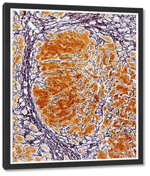 Cirrhosis of the liver, light micrograph