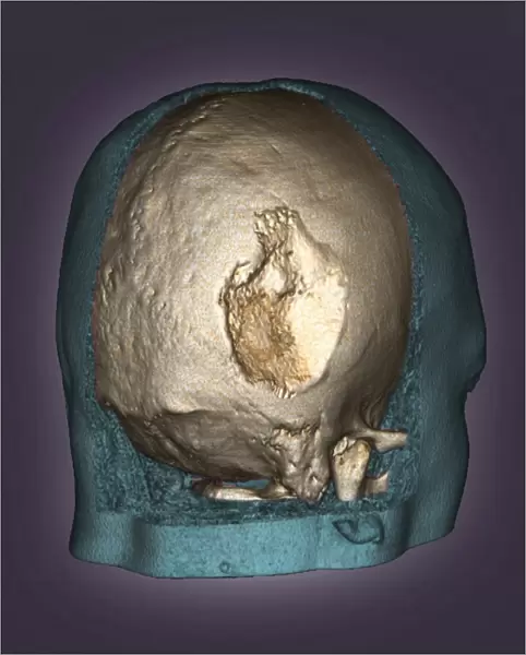Gorhams disease, 3D CT scan