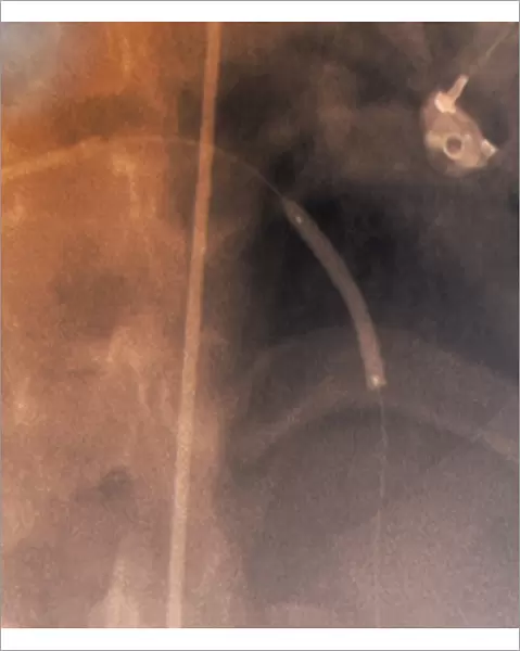 Coronary stenosis treatment, X-ray
