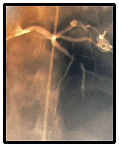 Coronary stenosis before treatment, X-ray