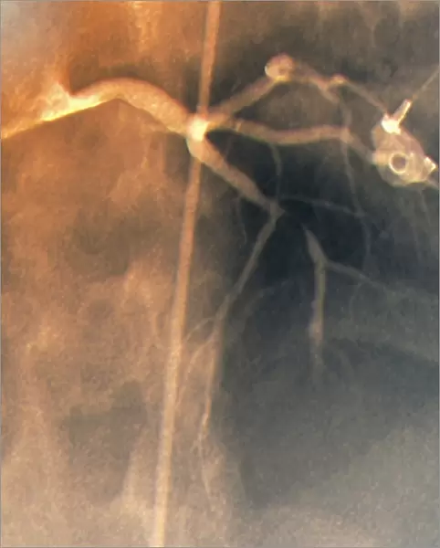 Coronary stenosis before treatment, X-ray