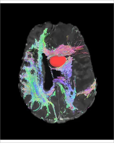 Brain tumour, DTI MRI scan C017  /  7059