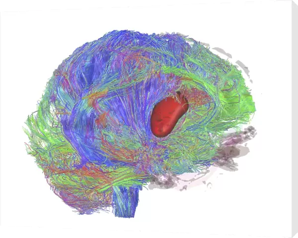 Brain tumour, DTI MRI scan C017  /  7057