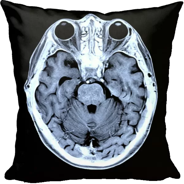 Coloured MRI scan of the human head F007  /  4205