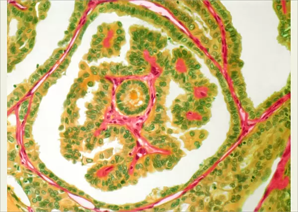 Thyroid cancer, light micrograph F005  /  6088