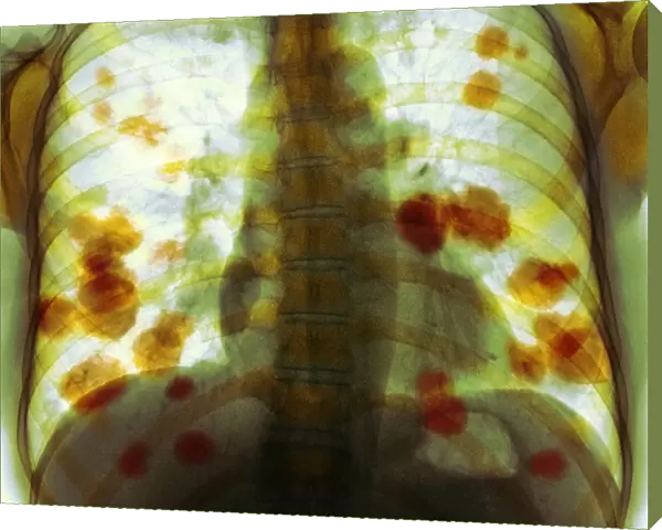 Secondary lung cancer, X-ray F008  /  3497