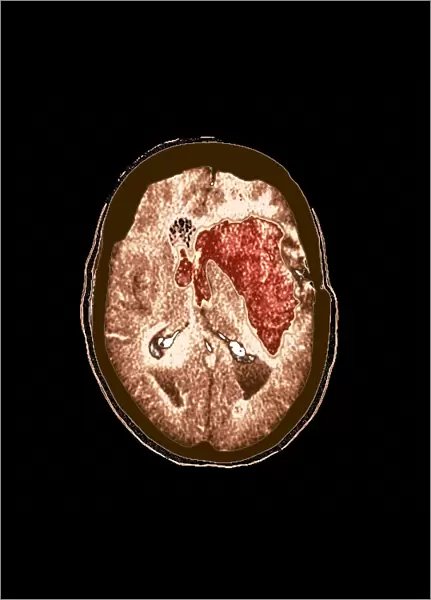 Brain haemorrhage, MRI scan F008  /  3468