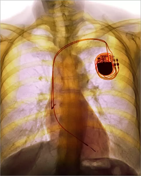 Dual chamber pacemaker, X-ray F008  /  3508