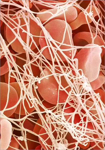 Blood clot, SEM P260  /  0123