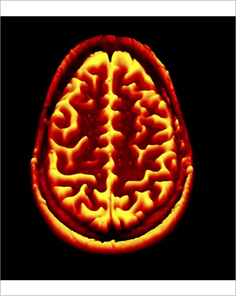 Brain scan, MRI scan, heightmap F006  /  7081