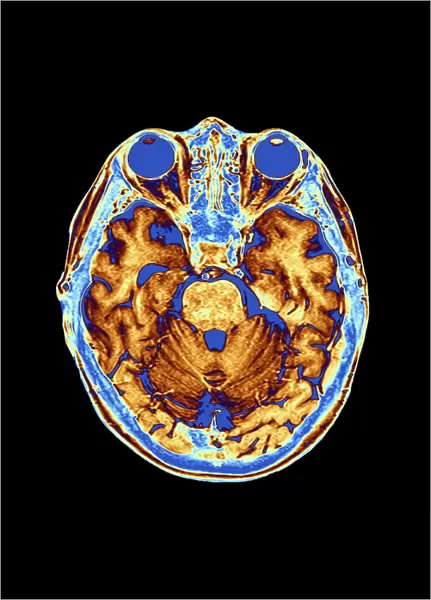 Coloured MRI scan of the human head F007  /  4202