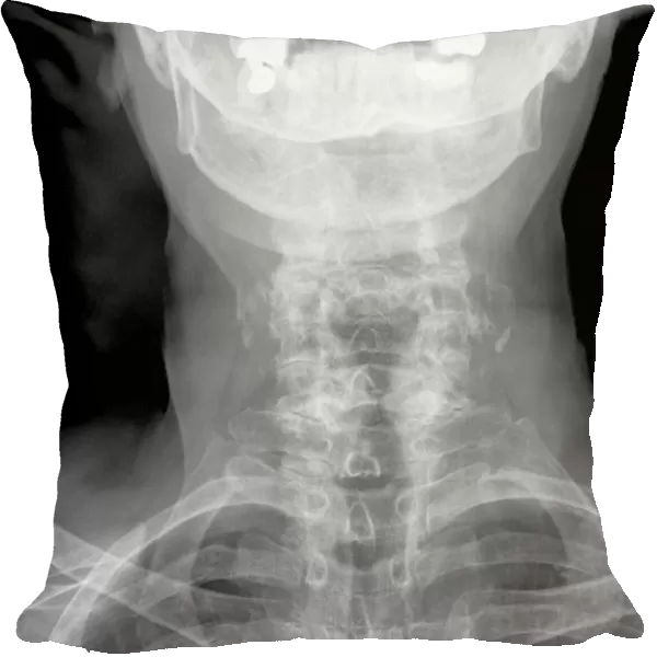 Arthritis of the neck, X-ray C017  /  7389