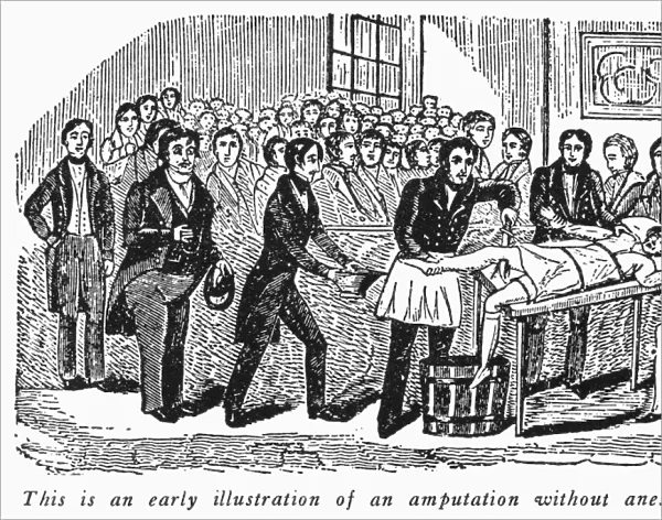 An amputation performed without anesthesia. Wood engraving, c1840