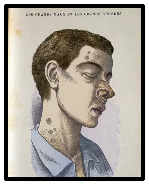 Man suffering from tertiary Syphilis. From Jules Rengade Le Grands Maux et les Grands Remedes