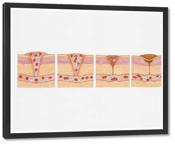 Illustration of formation of blood clot in series of four cross section illustrations showing blood oozing from blood vessel through wound before forming platelet plug