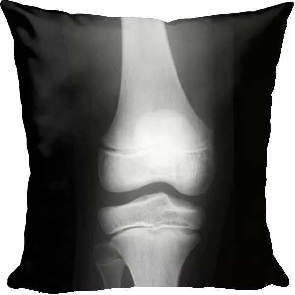 Normal childs knee, X-ray