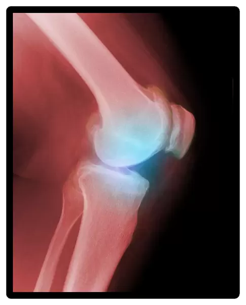 Arthritic knee, X-ray