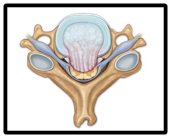Axial view of C5 showing herniated disk, compressed spinal cord and nerve roots