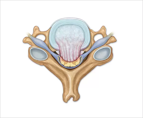 Axial view of C5 showing herniated disk, compressed spinal cord and nerve roots