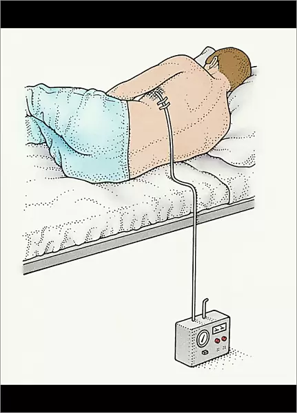 A man on a bed with a chest drain in his side recovering from pneumothorax (collapsed lung)