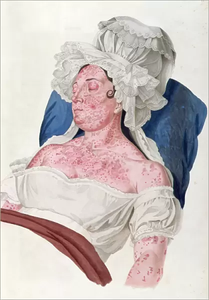 Woman with scarlet fever, from a book by Baron Jean Louis Alibert (1768-1837