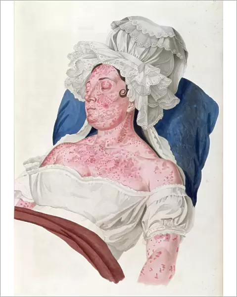 Woman with scarlet fever, from a book by Baron Jean Louis Alibert (1768-1837