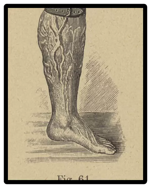 Tight garter causing varicose veins in the leg (engraving)