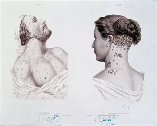 Symptoms of syphilis in men and women, from a medical book, c