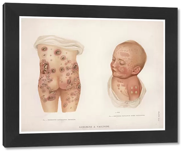 Diseases of the Skin: Gangrene and Vaccinide (colour litho)