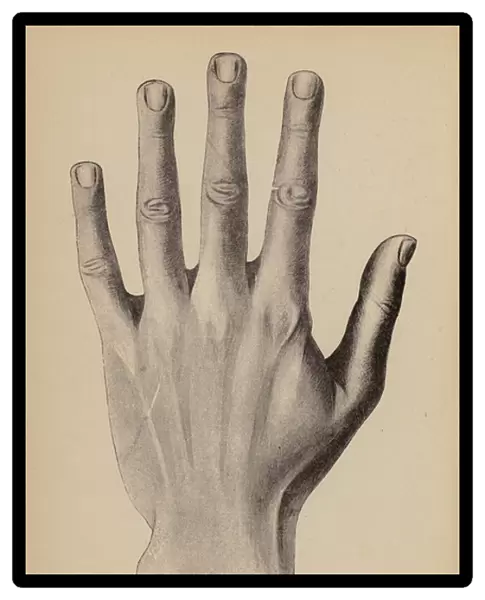 The Spatulate Hand (litho)