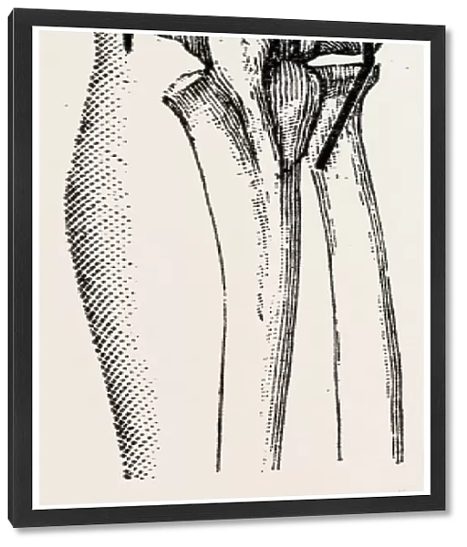 excision the elbow is now extended, medical equipment, surgical instrument, history