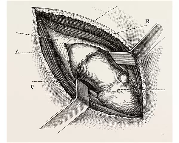 excision of the hip by an external incision, medical equipment, surgical instrument