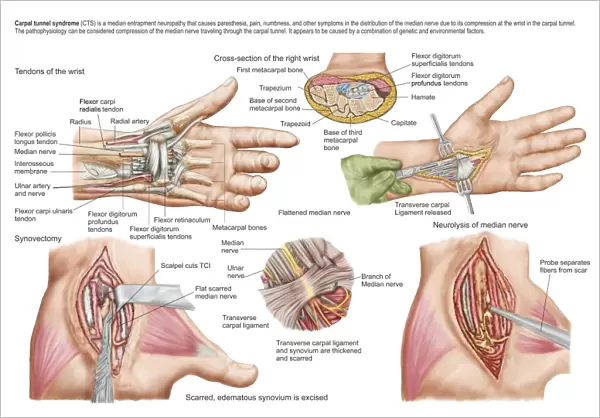 Medical illustration showing carpal tunnel syndrome in the human wrist