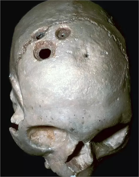 Trepanned Skull