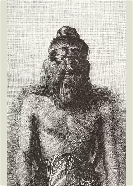 Moung Phoset, a male member of the Sacred Hairy Family of Burma. This familys hypertrichosis stretched over 5 generations. The Hairy Family was exhibited as freaks by PT Barnum for a season in the UK, and a brief tour in the US. in 1888. Hypertrichosis is an abnormal amount of hair growth over the body. From Ilustracion Artistica, published 1887