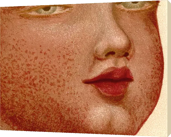 Eruptive Fevers: Scarlatina or Scarlet Fever. From The Household Physician, published c. 1898