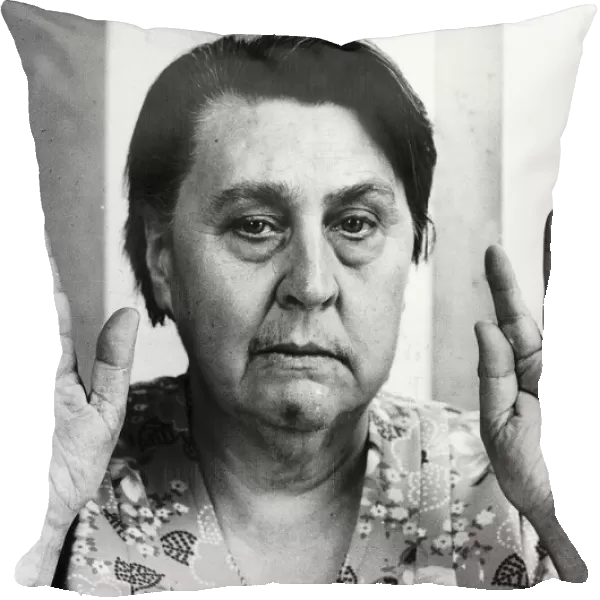 Stigmata sufferer Ethel Chapman shows her palms bearing the marks of the wounds of