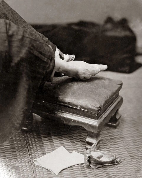 Bound foot, China, circa 1880s