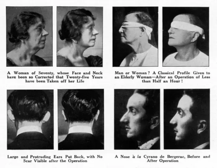 Framed Print : Before and After Plastic Surgery Print, 1927 Framed Print : Before and After Plastic Surgery Print, 1927