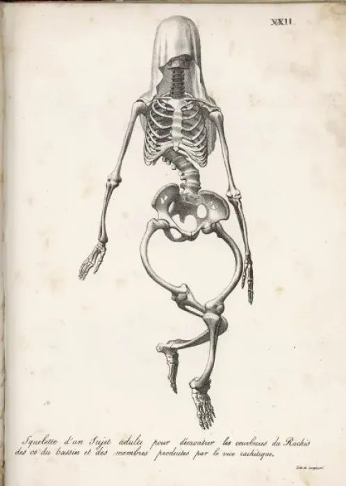 Framed Print : Rickets Skeleton Print Framed Print : Rickets Skeleton Print