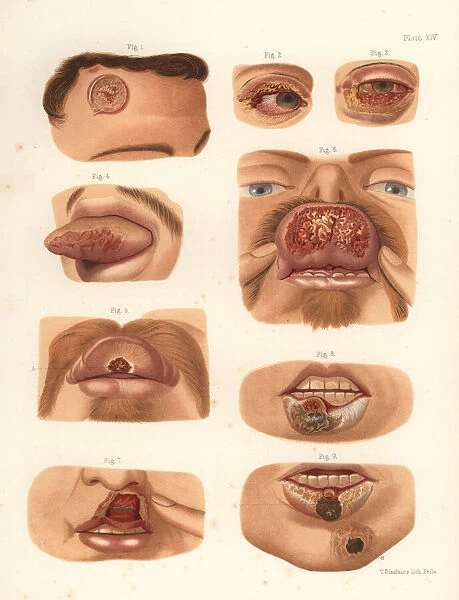 Syphilitic chancres on the face