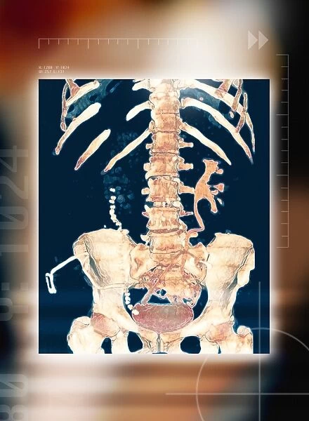 Abdominal bones, 3-D CT scan