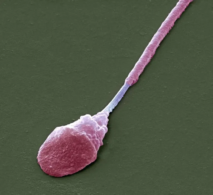 Framed Print : Abnormal sperm Print, SEM image at x8000 magnification Framed Print : Abnormal sperm Print, SEM image at x8000 magnification