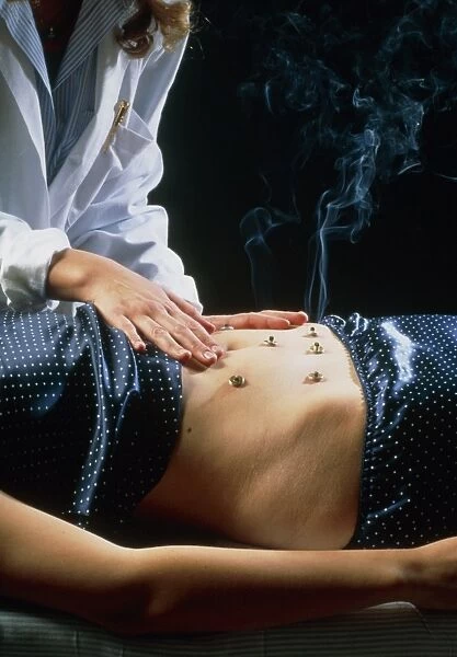 Acupuncturist carries out moxibustion on abdomen