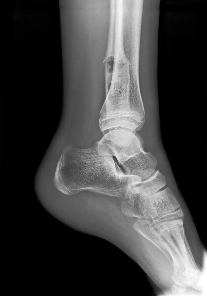 Ankle fracture with bone cyst, X-ray C017  /  7862