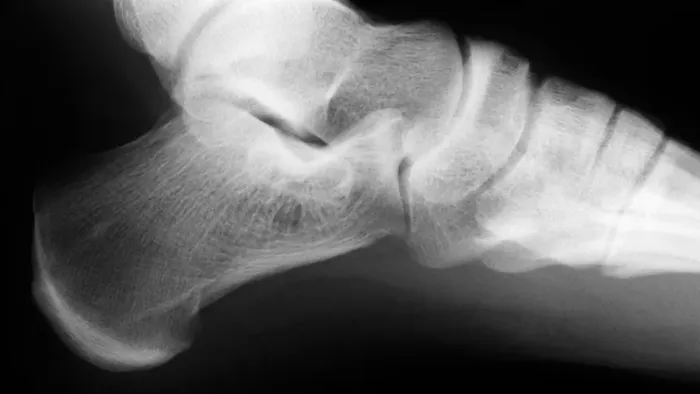 Framed Print : Normal Ankle Joint X-ray Print (Lateral View) Framed Print : Normal Ankle Joint X-ray Print (Lateral View)