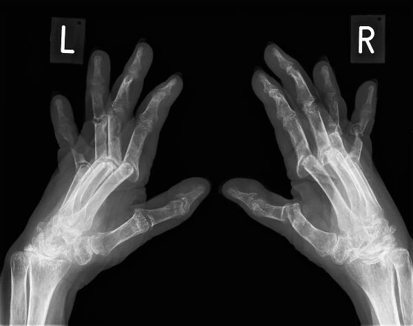 Arthritic hands, X-ray C017  /  7180