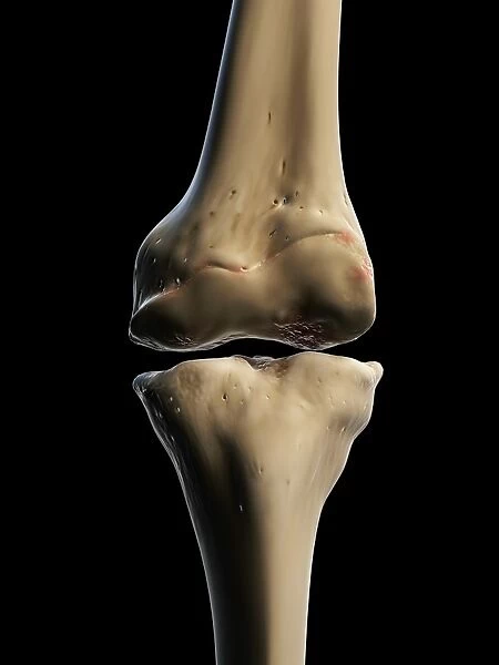 Arthritic knee, artwork F008  /  2476