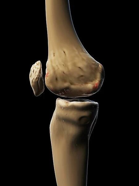 Arthritic knee, artwork F008  /  2477